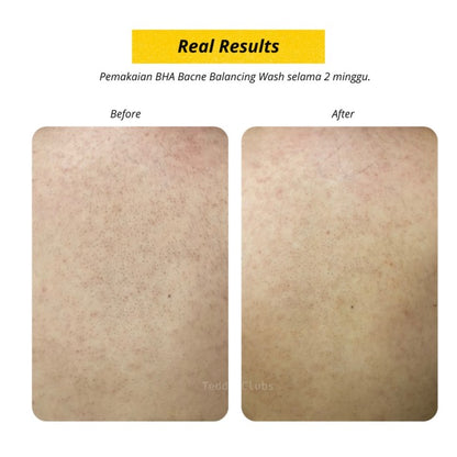 TEDDY CLUBS BHA BACNE BALANCING BODY WASH 236ML