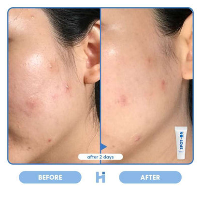 HALE SPOT ON ACNE GEL 10 GR